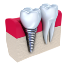 Mini Dental Implants
