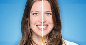 Invisalign-v-braces