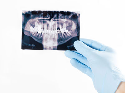 Jaw Dental Xray - Osteoporosis