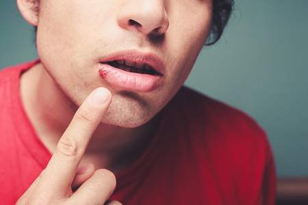 Young man with cold sores