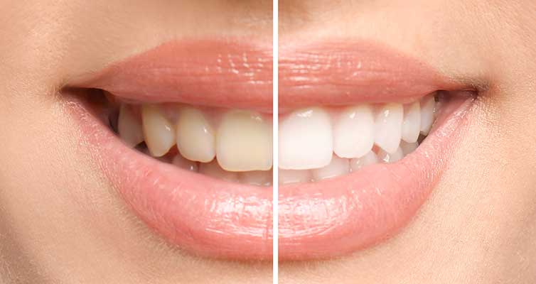 Whiten My Smile
